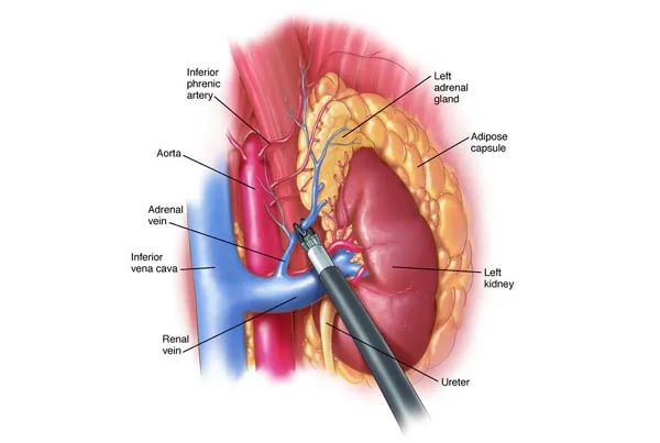 Lap Adrenalectomy