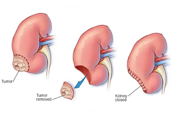 Lap / Partial Nephrectomy