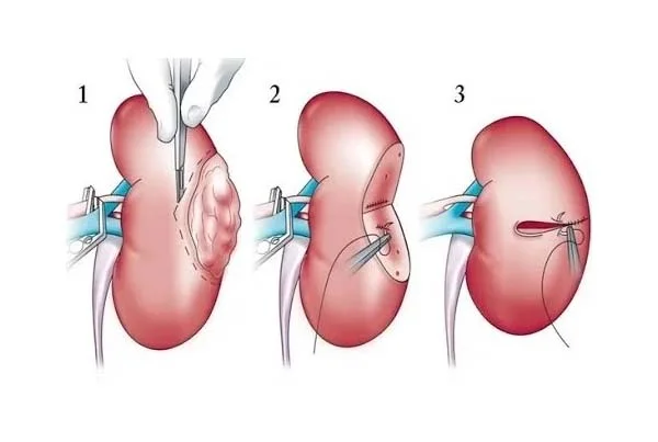 Lap Nephroureterectomy