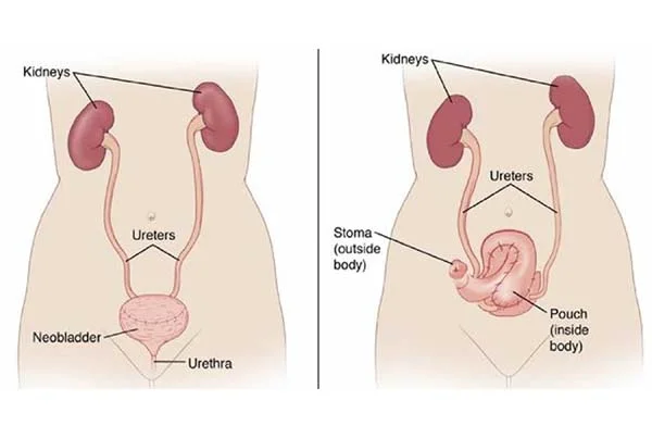 Radical Cystectomy with Urinary Diversion