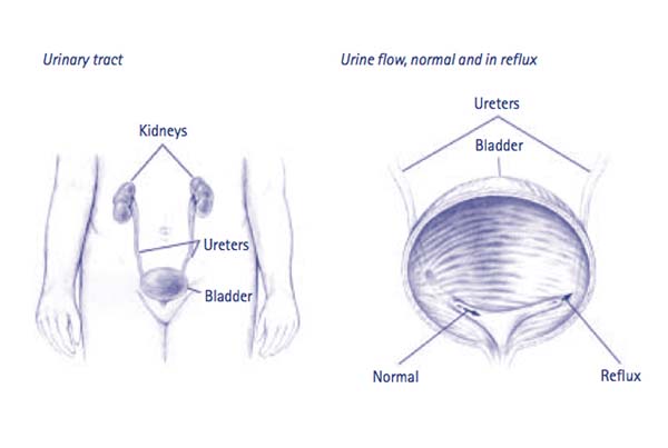 Ureteral Reimplantation