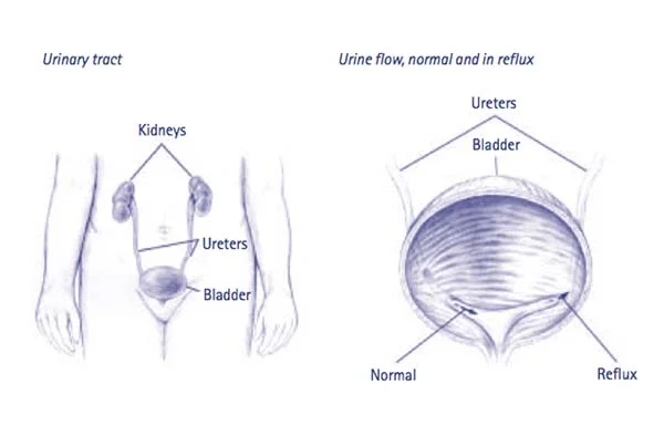 Ureteral Reimplantation