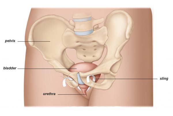 Sling Surgery for Stress Urinary Incontinence