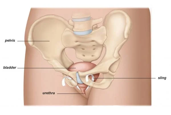 Sling Surgery for Stress Urinary Incontinence