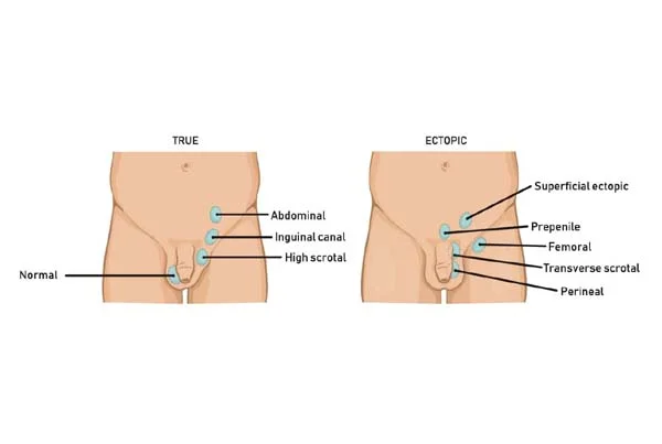 Undescended Testis Surgery