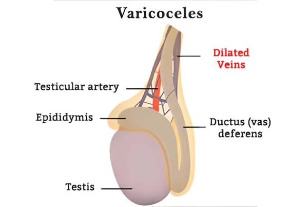 Microscopic Ligation of Varicocele